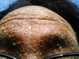 なかなか治らない頭皮のかさぶた対策 頭皮ｓｏｓ 意外と知らない頭皮の病気 原因と対策